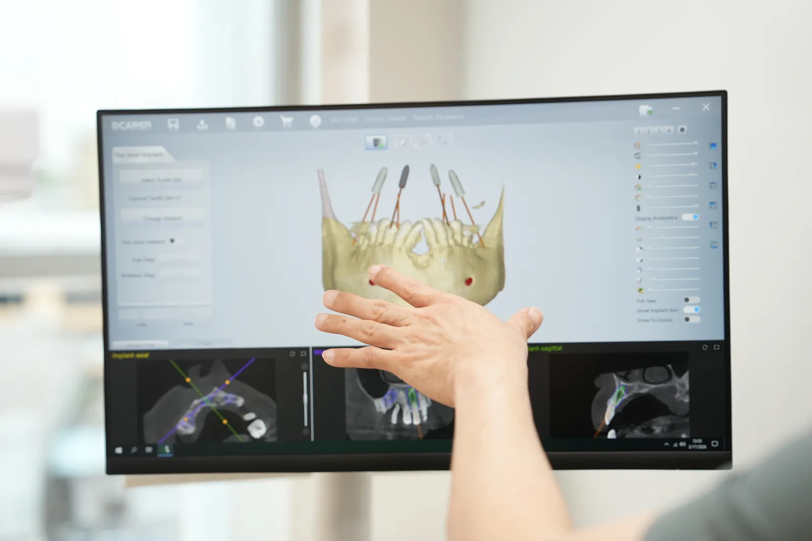 A dentist pointing to an implant position on the planning screen
