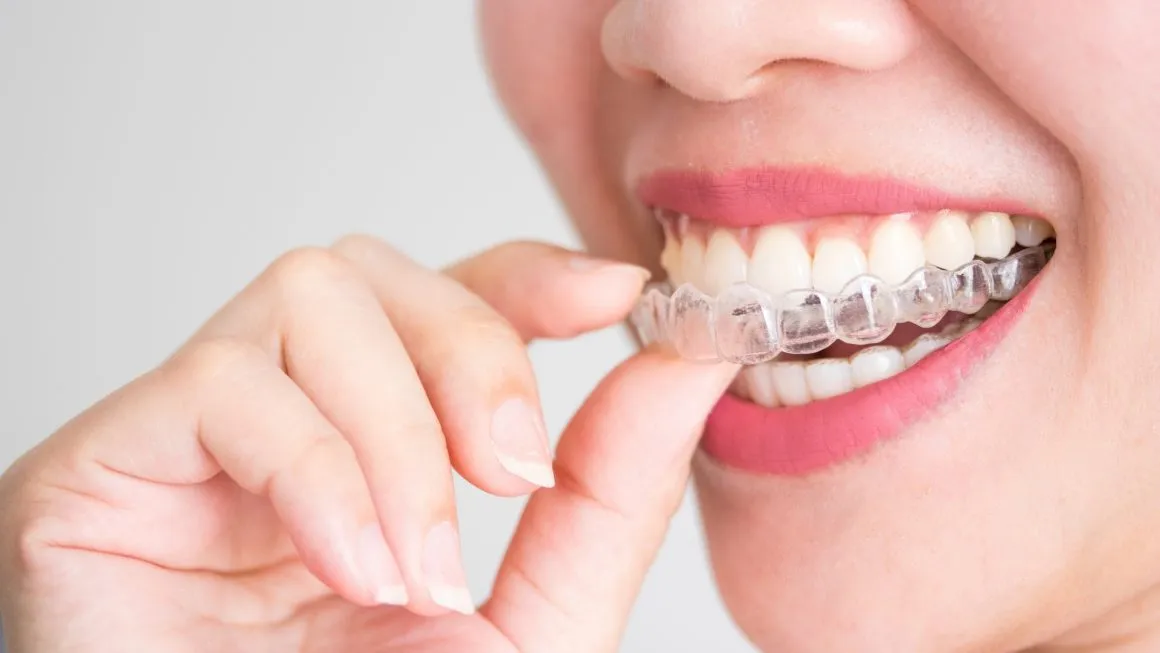 A person fitting a clear aligner over their upper teeth.