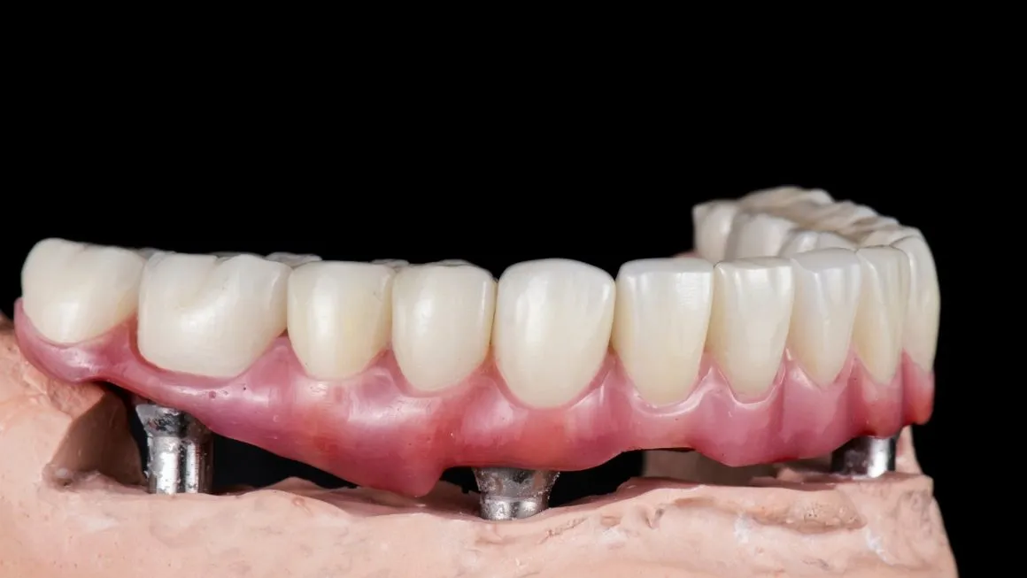 A full-arch implant prosthesis on a stone model, seen from the front.