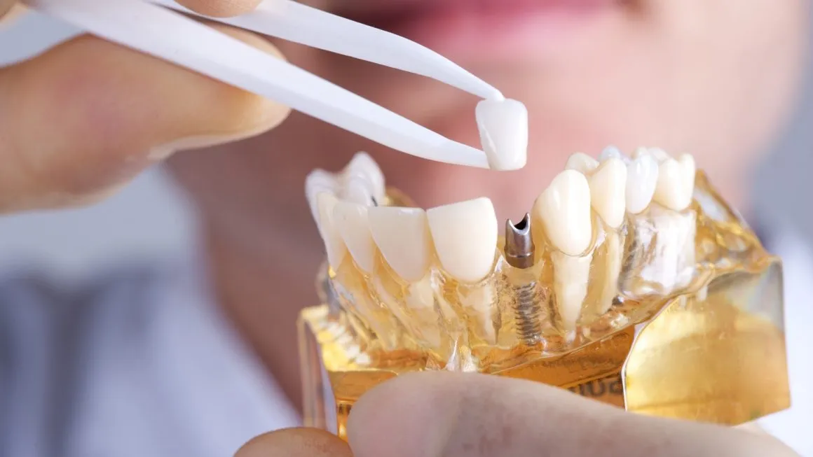 A dental model of a jaw with a single implant, and a crown held above it with tweezers.