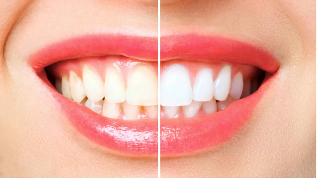 ภาพระยะใกล้ของรอยยิ้มแบ่งครึ่ง เปรียบเทียบสีฟันเข้มกับสีฟันที่ขาวขึ้น