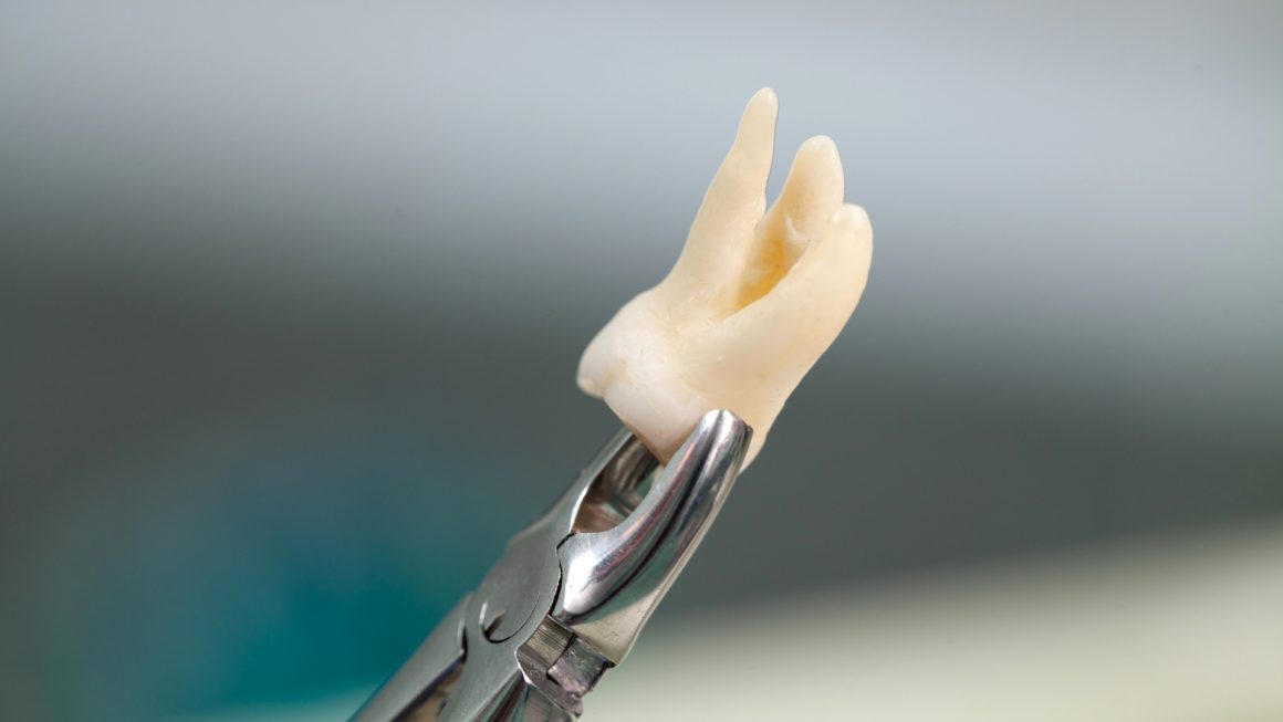 Tooth Extraction