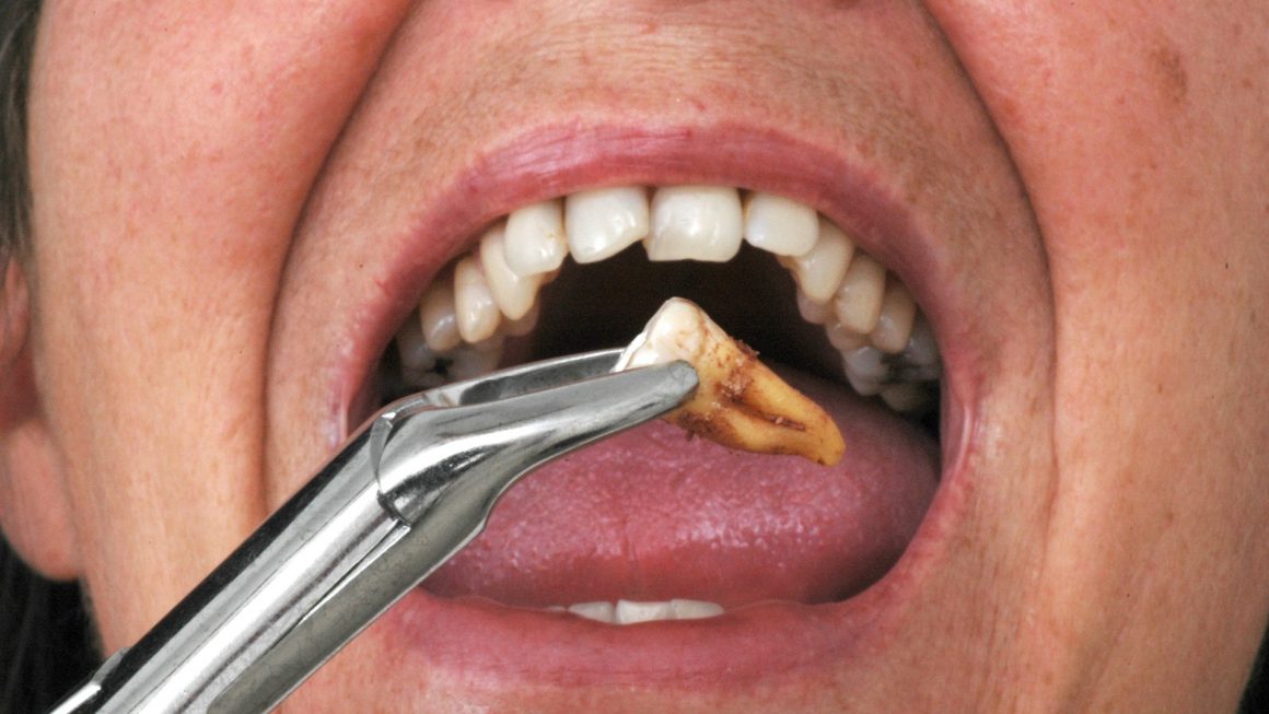 Tooth Extraction