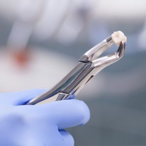 Tooth Extraction