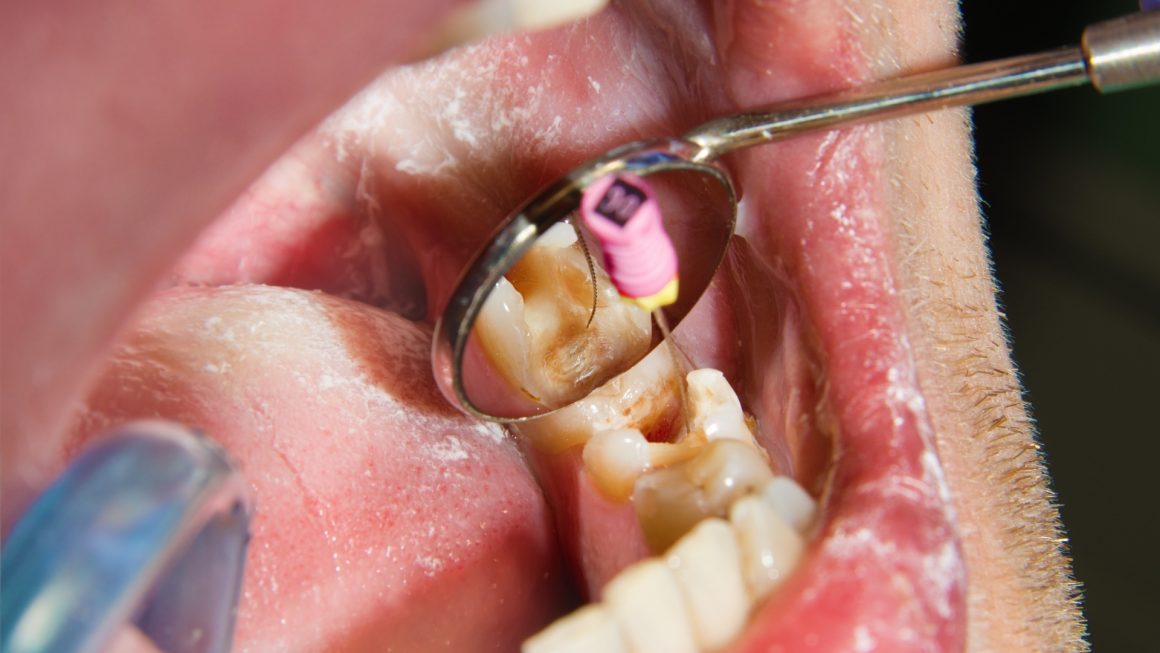 Root canal treatment / cutting off the tip of the tooth root