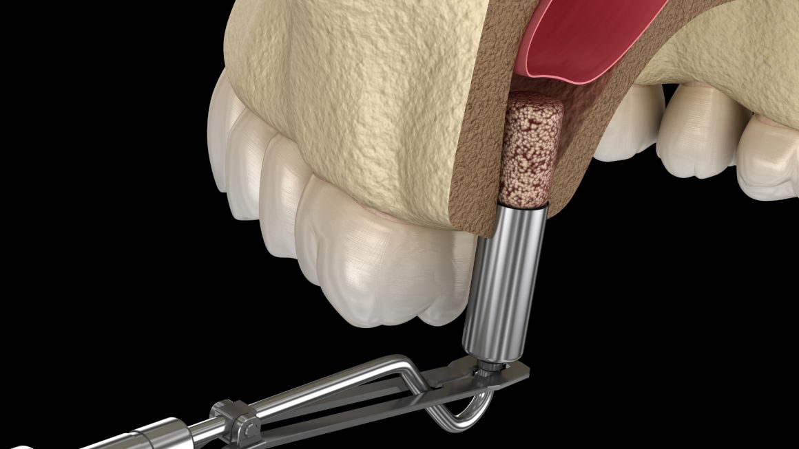 Bone graft (Bone Graft/ Sinus lift)