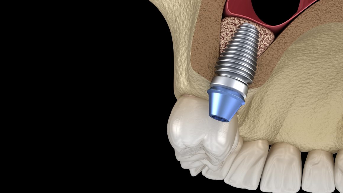 Bone graft (Bone Graft/ Sinus lift)