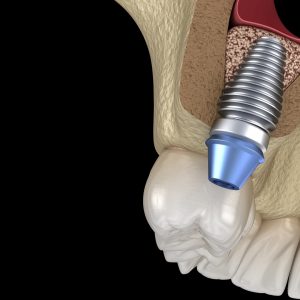 Bone graft (Bone Graft/ Sinus lift)