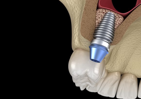 Bone graft (Bone Graft/ Sinus lift)