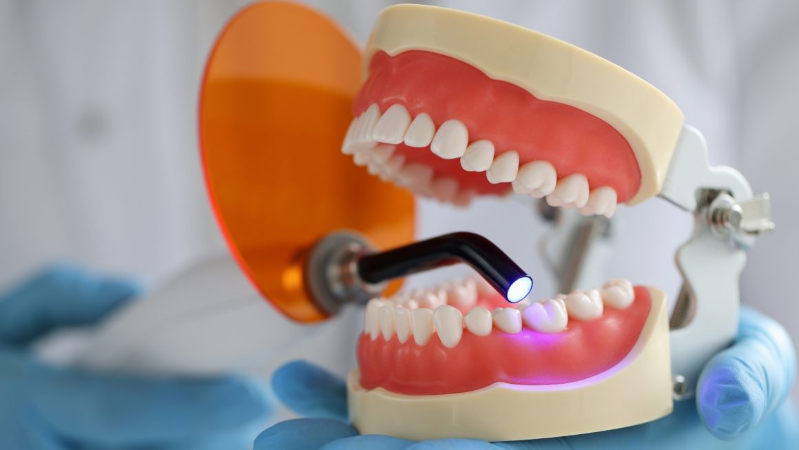 Dental fillings to close Diastema