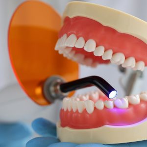 Dental fillings to close Diastema