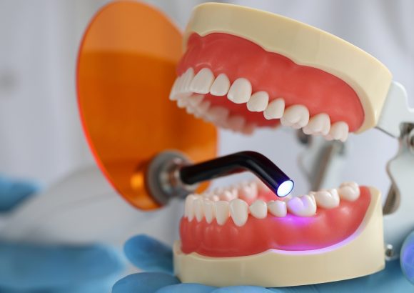 Dental fillings to close Diastema