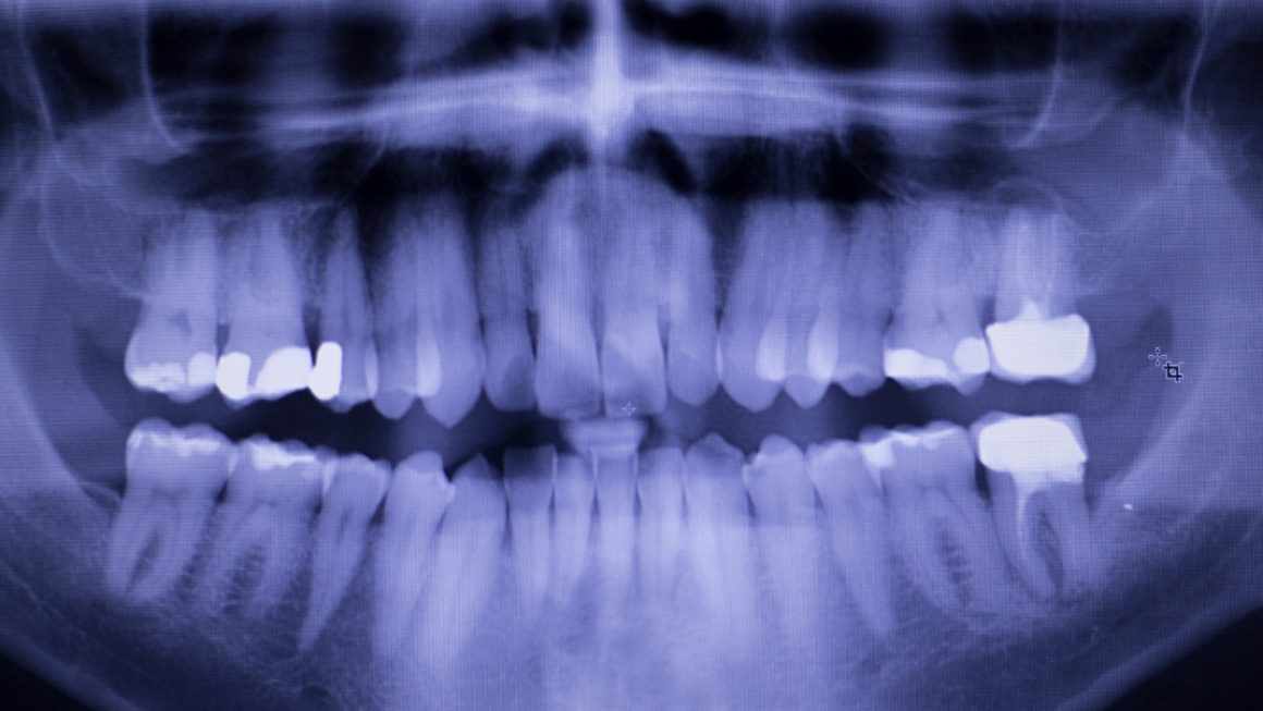 Dental fillings to close Diastema