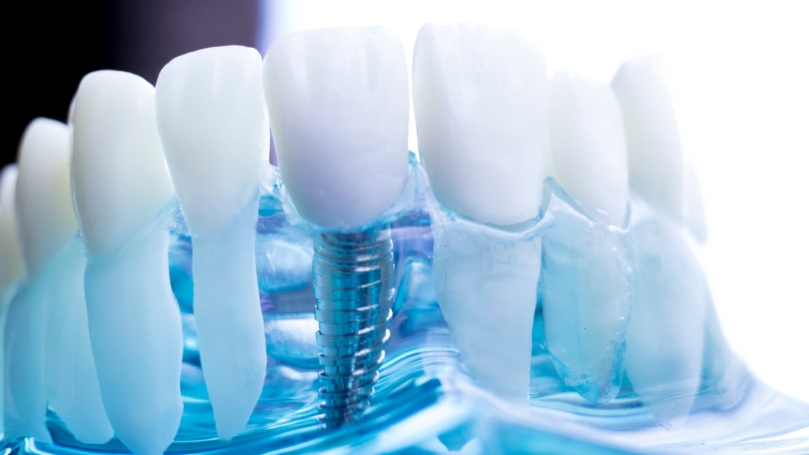 Dental implants