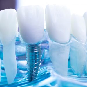 Dental implants