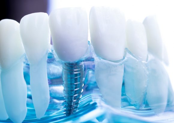 Dental implants