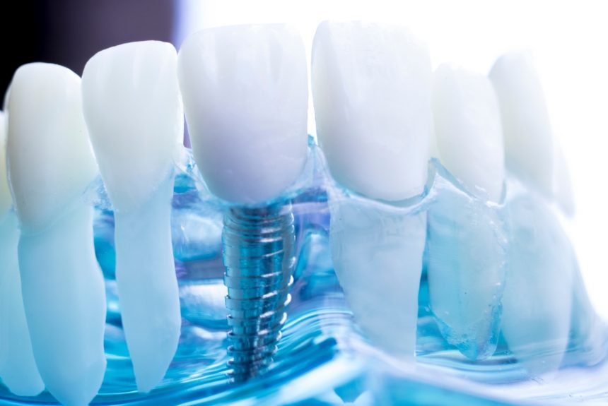 Is it possible to get dental implants in one day?