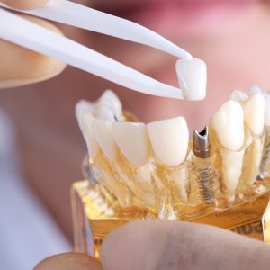 What is dental implant ?