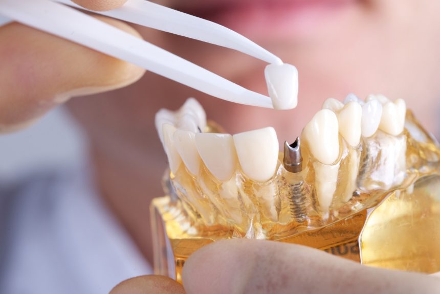 What is dental implant ?
