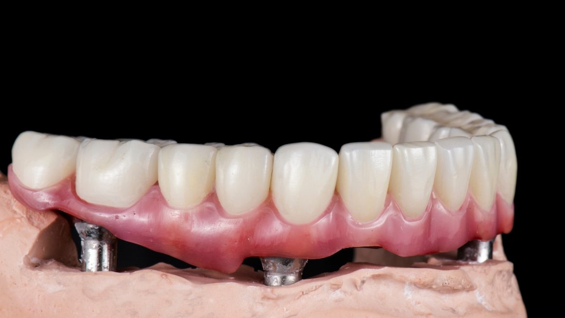 What are the benefits of full-mouth dental implants?