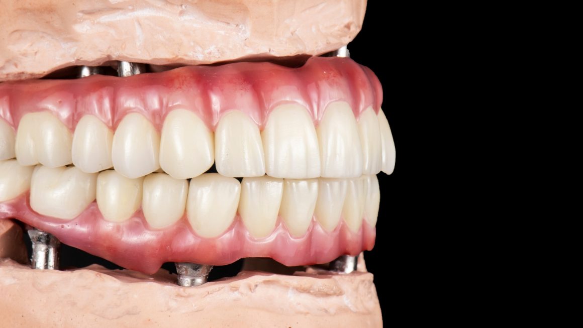 What are full-mouth dental implants or ALL ON?