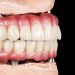 What are full-mouth dental implants or ALL ON?