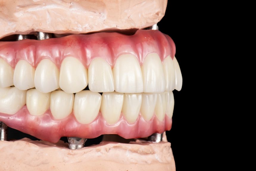 What are full-mouth dental implants or ALL ON?