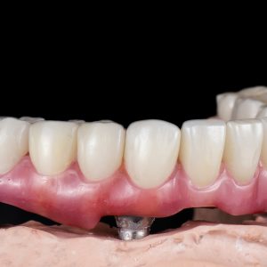 What are the benefits of full-mouth dental implants?