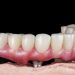 What are the benefits of full-mouth dental implants?