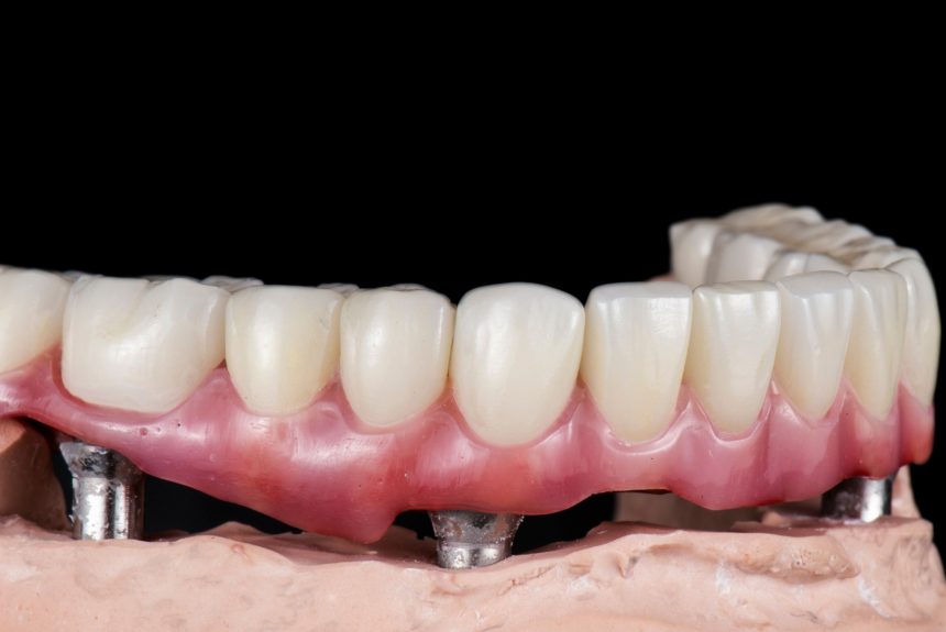 What are the benefits of full-mouth dental implants?