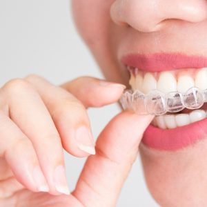 Clear Braces or Metal Braces: What’s the Difference?