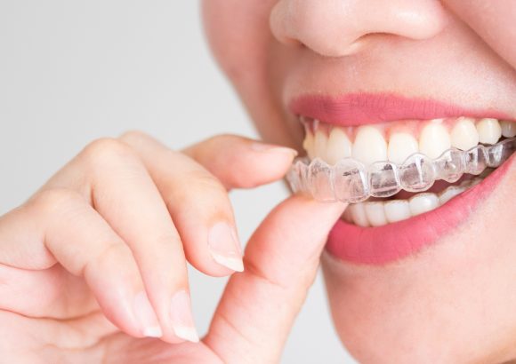 A clear retainer