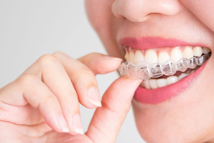 Clear Braces or Metal Braces: What’s the Difference?