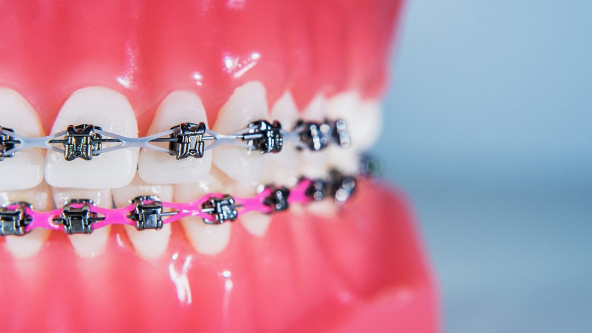 Clear braces/wires (Orthondotic Treatment)