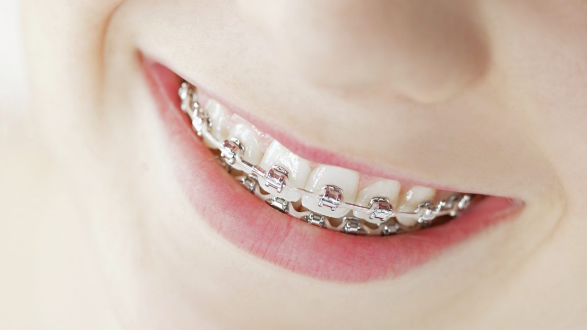 Clear braces/wires (Orthondotic Treatment)