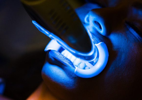 Teeth whitening