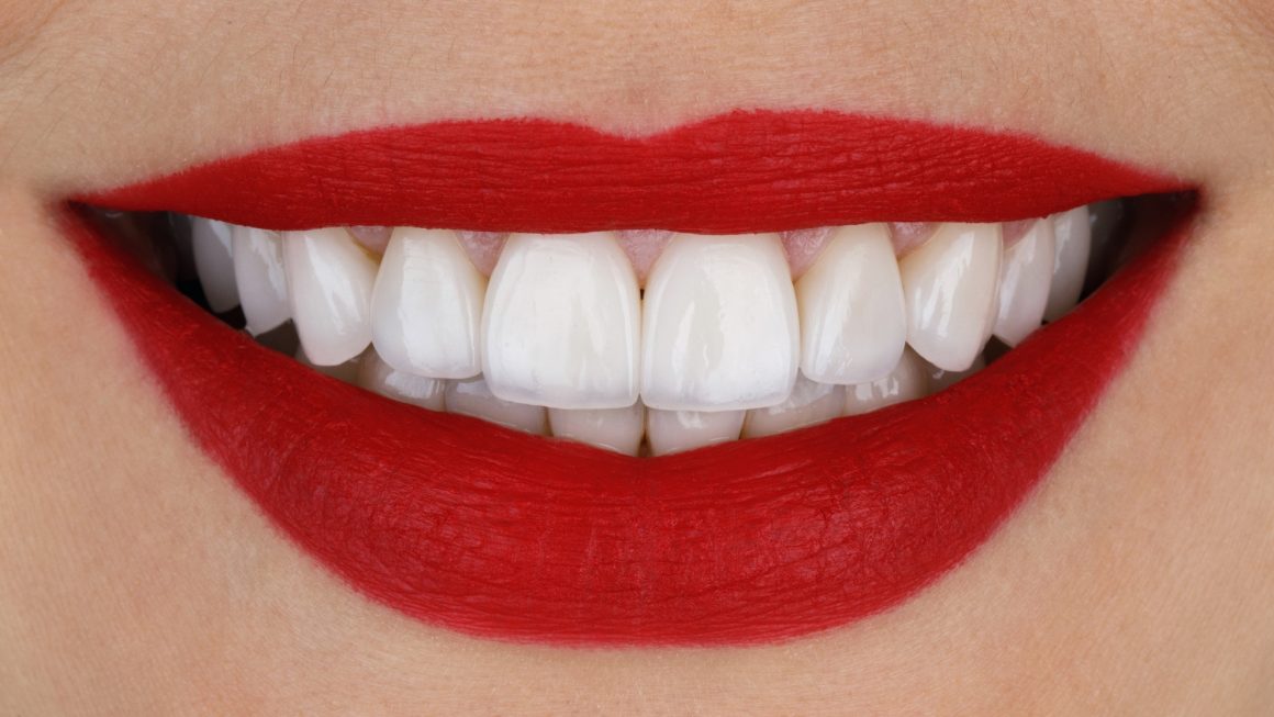 Veneers