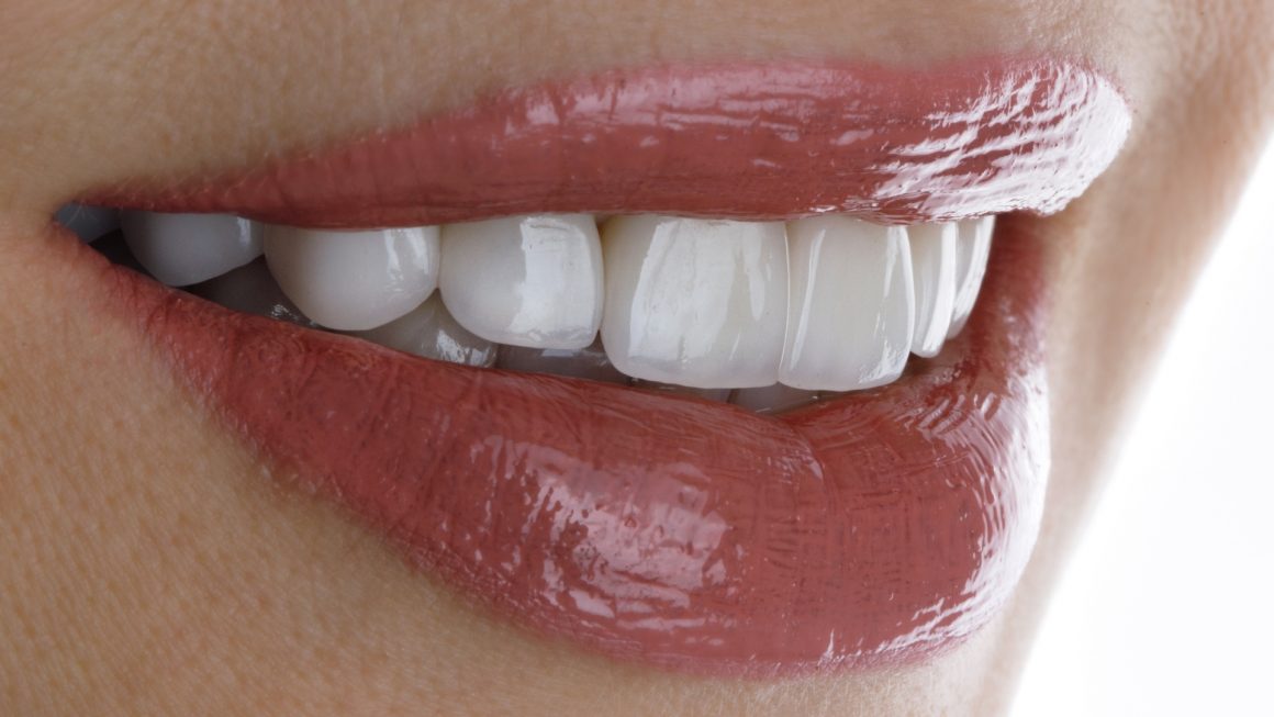 Veneers