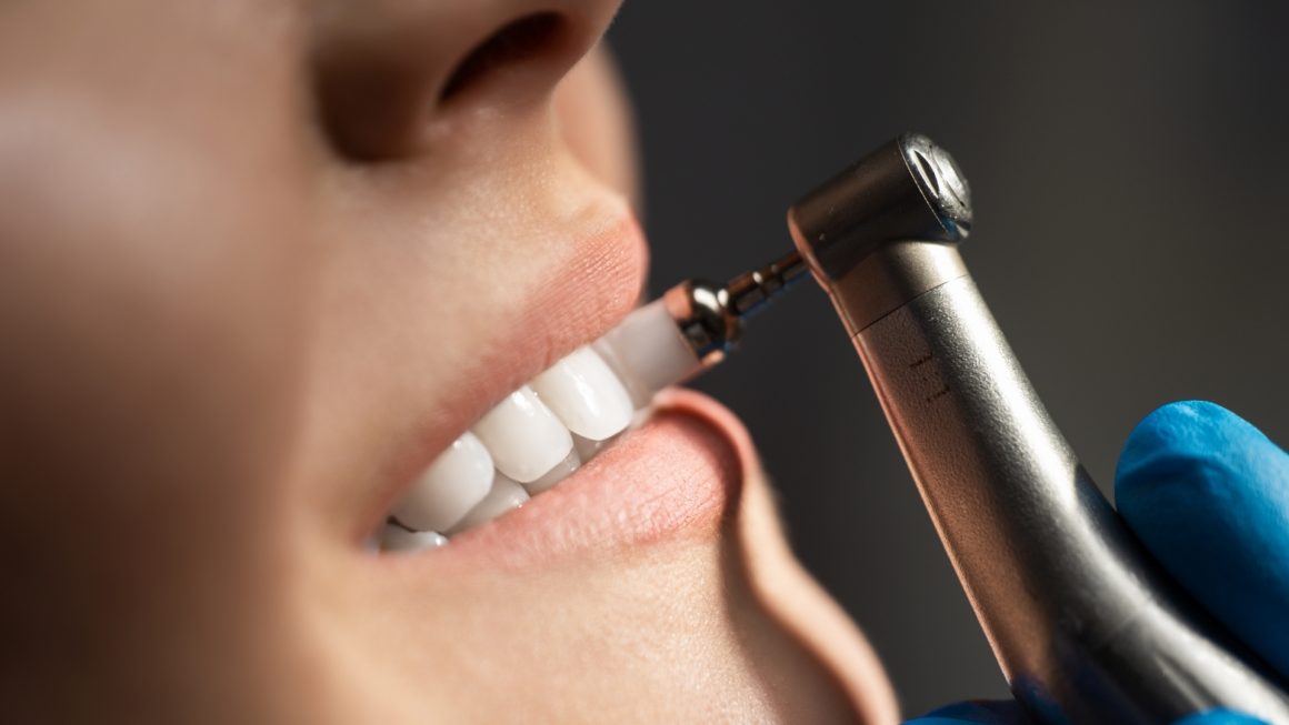 Teeth Cleaning, Scaling and Polishing