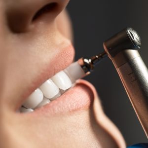 Teeth Cleaning, Scaling and Polishing