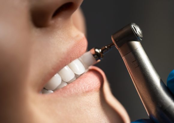 Teeth Cleaning, Scaling and Polishing