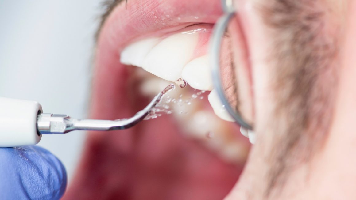 Teeth Cleaning, Scaling and Polishing