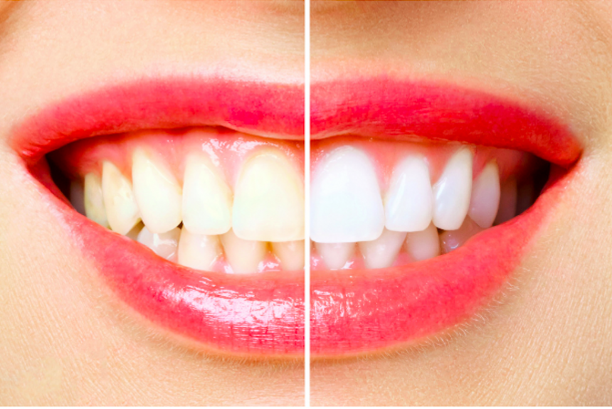 Teeth Whitening