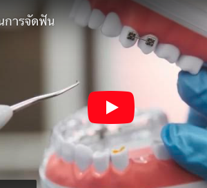 5 ขั้นตอนการจัดฟันใส