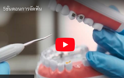 5 ขั้นตอนการจัดฟันใส