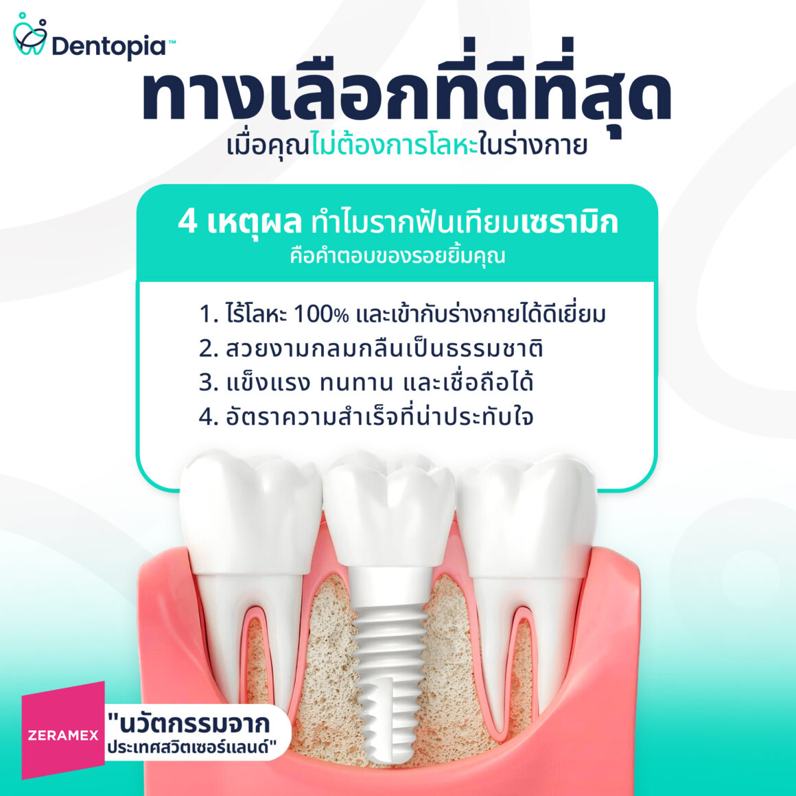 Ceramic_Implants รากฟันเทียมเซรามิก (Ceramic Implants) นวัตกรรมเพื่อรอยยิ้มที่เป็นธรรมชาติ